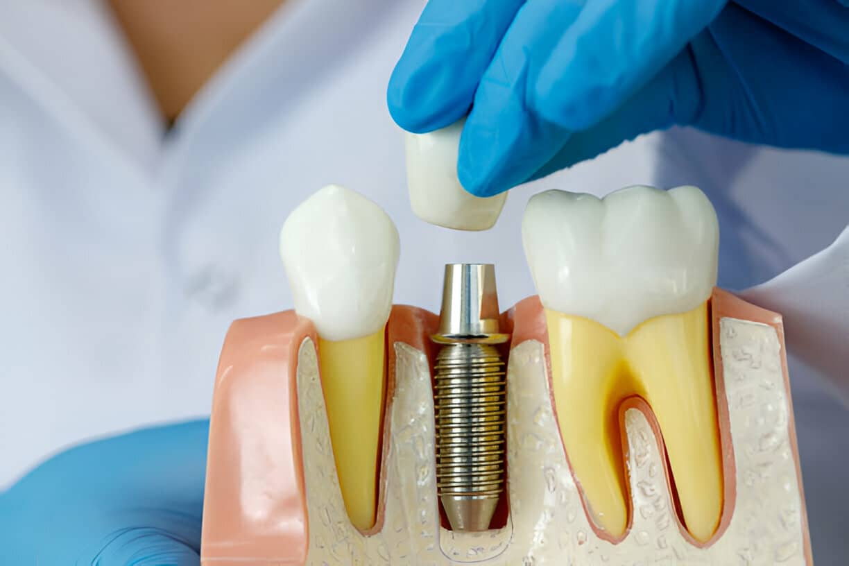 Are You a Candidate for Dental Implants? Find Out Now