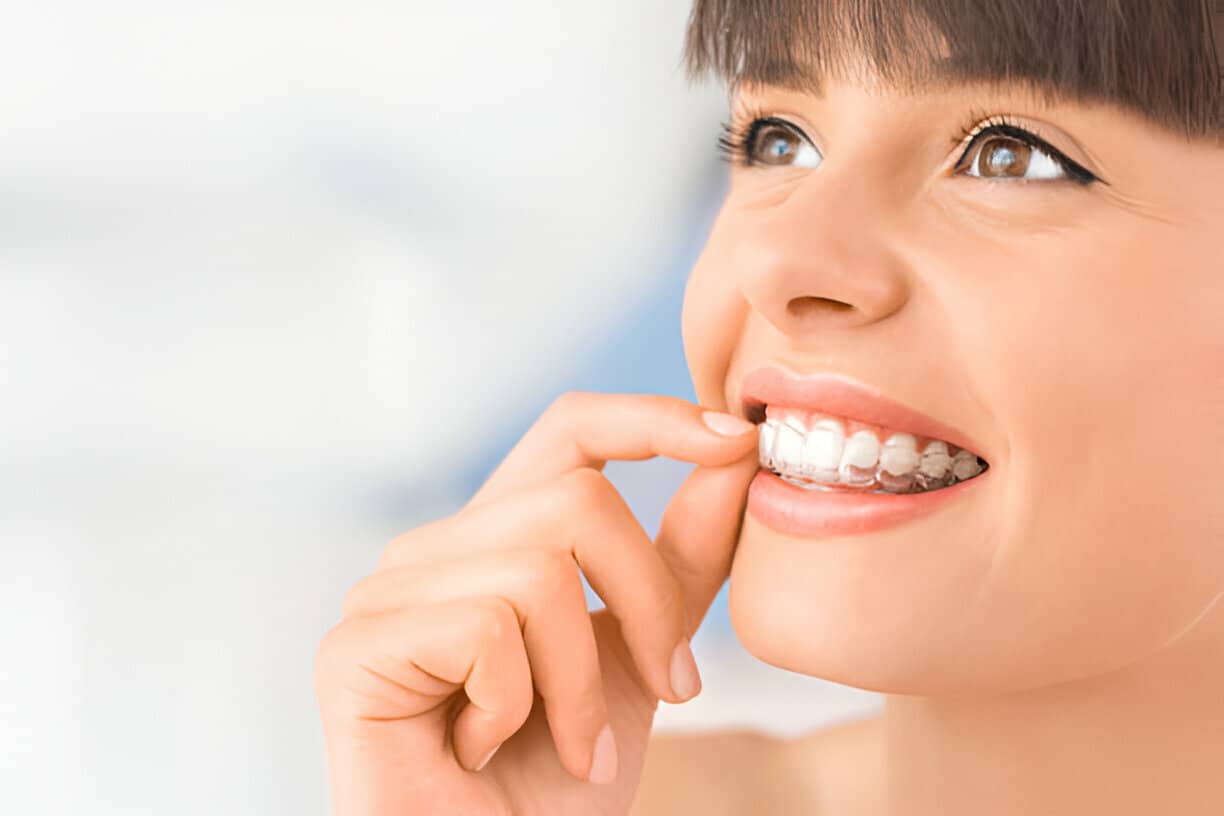 5 Reasons Why You Should Consider Invisalign